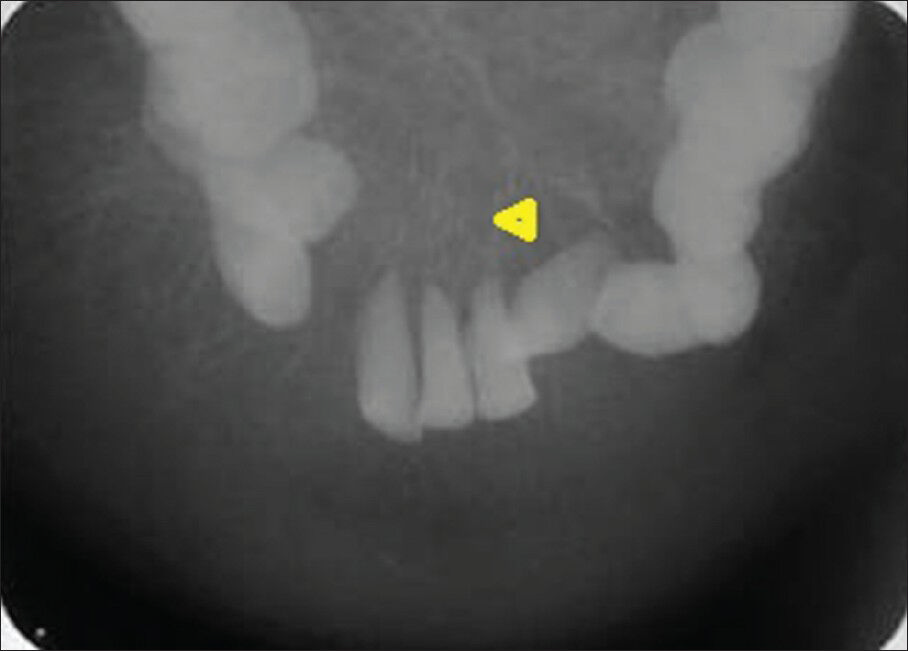 72-year-old male with a swelling in the mandible and the left lower leg, diagnosed with multiple myeloma. Conventional mandibular cross-sectional occlusal radiograph reveals radiating bony spicules (arrowhead) perpendicular to the lower dental arch, missing left canine, and displaced first premolars and right canine.